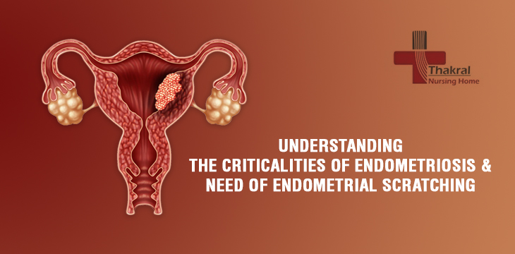 Understanding the Criticalities of Endometriosis & Need of endometrial Scratching