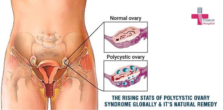Polycystic-Ovary-Syndrome-Globally-Its-Natural-Remedy